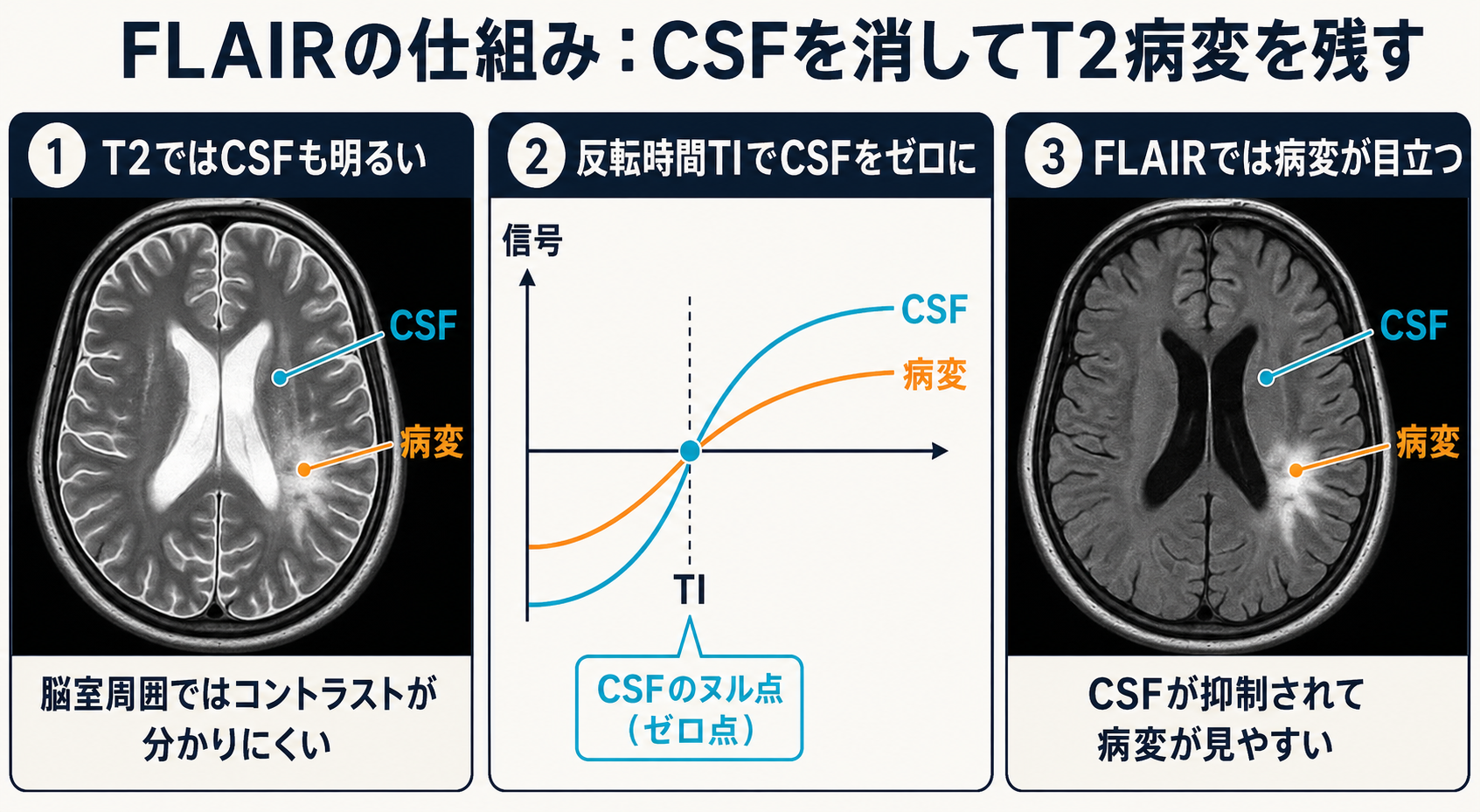 FLAIRのCSF抑制メカニズム