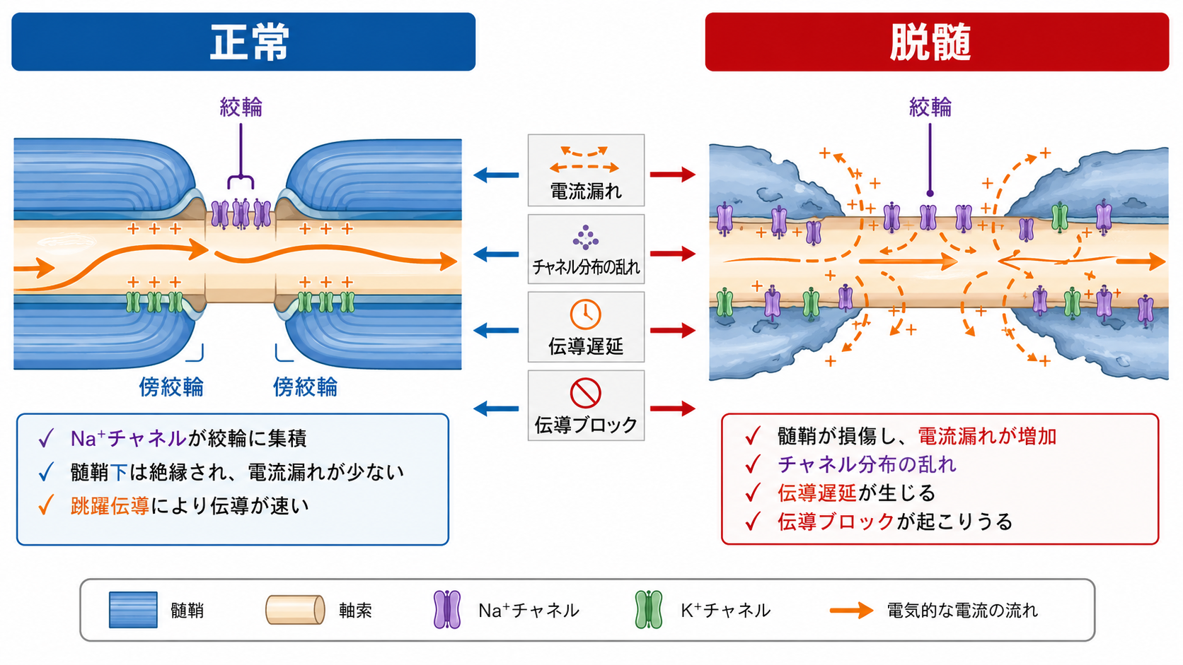 正常な有髄軸索と脱髄時の違い