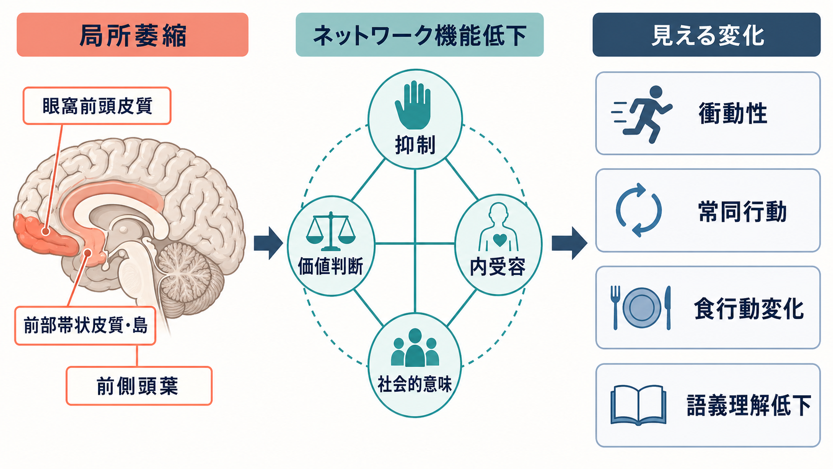 前頭側頭型認知症のネットワーク機序