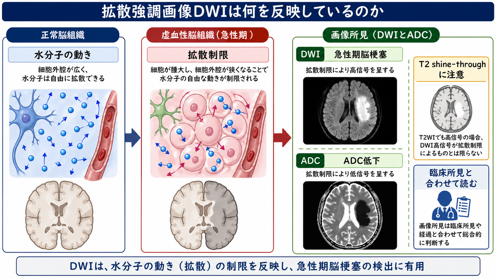DWIが反映する拡散制限の概念図