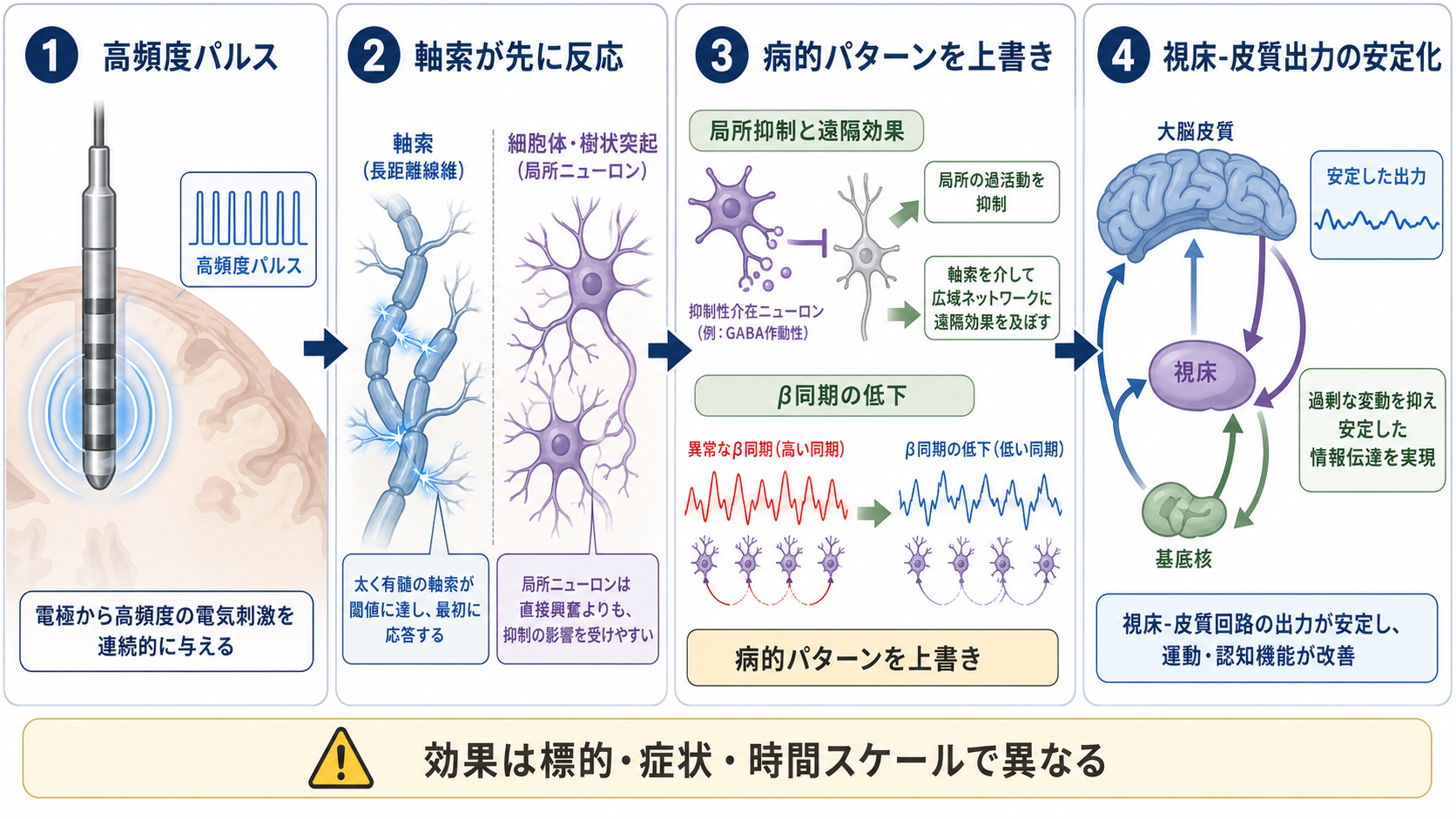 DBSの高頻度刺激が病的パターンを上書きする仕組み